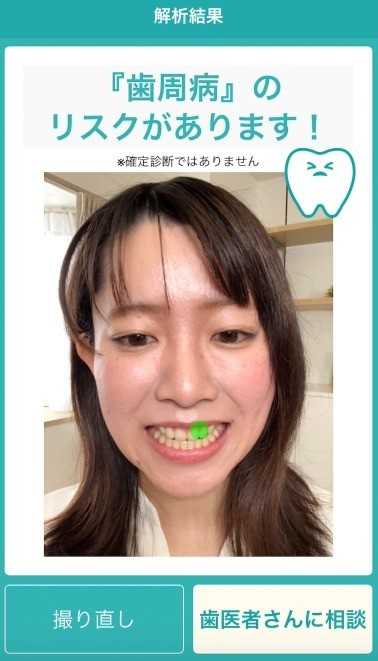 口腔疾患を発見する機能を用いたデモアプリ