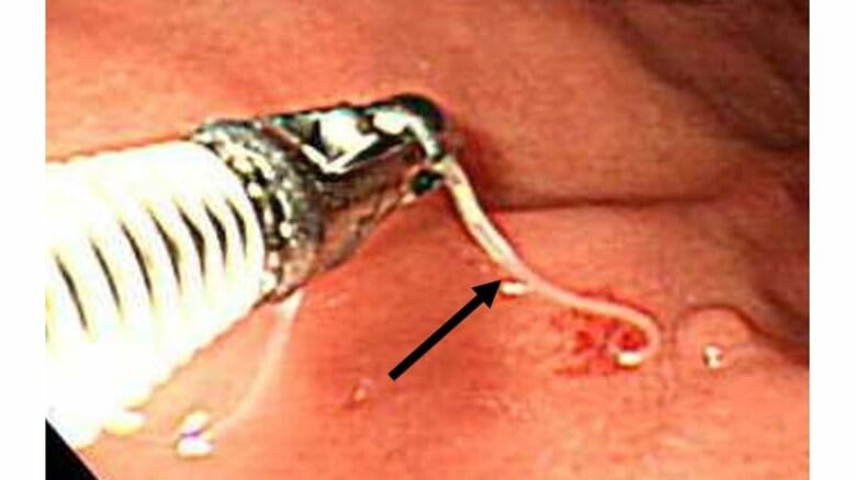 内視鏡の先端に装着された鉗子でアニサキスの幼虫を摘出する（画像提供：国立感染症研究所）