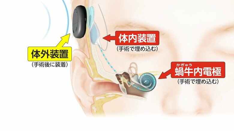 「人工内耳」電気で耳の神経を刺激し脳で音や言葉の感覚を得られるという（提供：日本コクレア/虎の門病院）