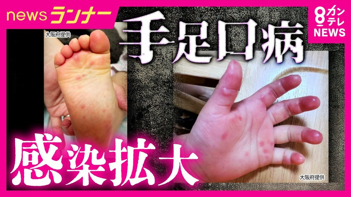 全国で「手足口病」が流行 大阪・京都でも警報レベルに 特効薬ない中で