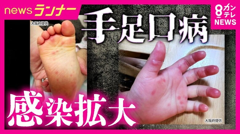 全国で「手足口病」が流行 大阪・京都でも警報レベルに 特効薬ない中での対策は「しっかり手洗い・タオルの共有を避ける」 保育現場では「紫外線で殺菌」など対策も|FNNプライムオンライン