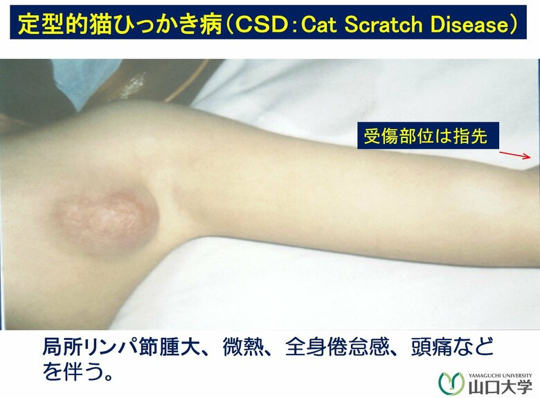 指先に傷を受け、脇の下のリンパ節が腫れた例（提供：山口大学）