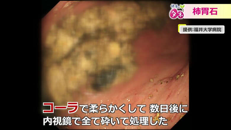 砕かれた柿胃石