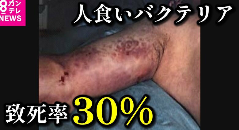 致死率30％「人食いバクテリア」患者数が過去最多に　手足の筋肉の壊死する「非常に進行の速い感染症」｜FNNプライムオンライン