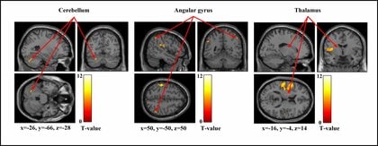 【新潟医療福祉大学】「痛みの感じ方」は人によって違う？刺激の強さで変わる脳のはたらきを解明！