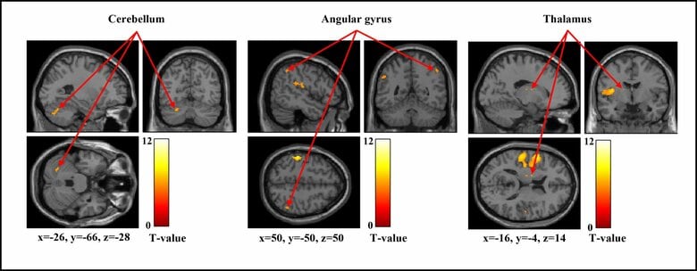 【新潟医療福祉大学】「痛みの感じ方」は人によって違う？刺激の強さで変わる脳のはたらきを解明！