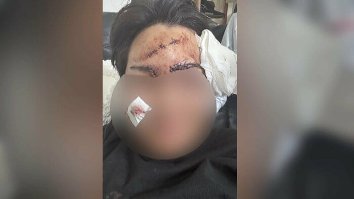 被害者の男性が負った20針縫った傷