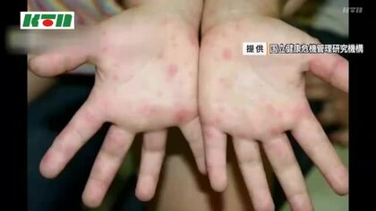  手足口病の報告数減少も警戒レベル継続　新型コロナも8週続けて増加