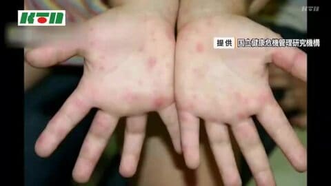  手足口病の報告数減少も警戒レベル継続　新型コロナも8週続けて増加