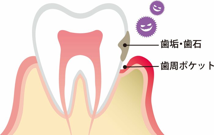 口腔ケアを怠ると歯周ポケットが深くなってしまう（イメージ）